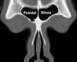 Image result for Sinus CT