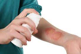 Ultimate Trampoline Burn Treatment: How Long + How To Heal