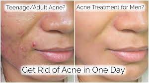 How To Get Rid Of Pimples In 1 Day || My Acne Skincare Routine - Youtube