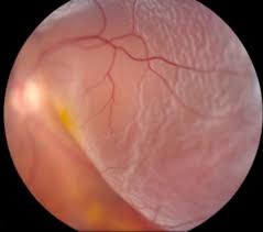 Image result for Retinal Detachment