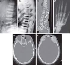 Osteosclerosis An Overview Sciencedirect Topics