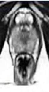 prostate cancer is a paradox. Pi Rads V2 In Prostate Cancer And Correlation With T Staging Psa Levels And Adc Values Iranian Journal Of Radiology Full Text