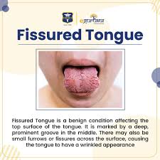 Image result for Fissured tongue