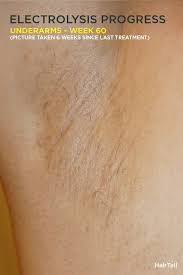 We use the spectacular stellar m22 laser removal device partnered with the advanced zimmer cryo 6 machine. Electrolysis Log Numbers Graph And Pictures Professional Electrolysis Hairtell Hair Removal Forum By Andrea James