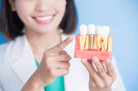 Everything You Should Know About All On 6 Dental Implants! | Engel Dental  Center
