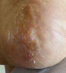 In severe cases, dyshidrotic eczema can become debilitating. Dyshidrotic Eczema Reddit Post And Comment Search Socialgrep