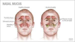 Dear Mayo Clinic My Grandson Frequently Has A Runny Nose And The Color Of The Nasal Mucus Is Sometimes Green In 2020 Acute Sinusitis Sinusitis Mucus