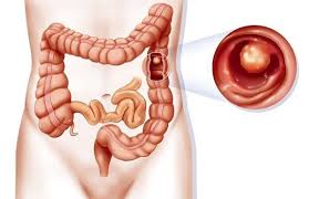 Trực tràng là phần cuối cùng của đại tràng gần hậu môn. Polyp Ä'áº¡i Trang La Gi Triá»‡u Chá»©ng Cach Chá»¯a Trá»‹ Polyp Ä'áº¡i Trang