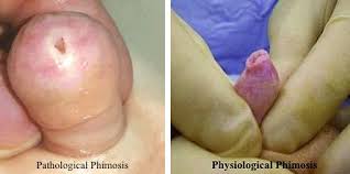 Image result for Phimosis