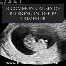 Bloody show is another sign that labor is on the way. 8 Common Causes For Bleeding In The First Trimester Wehavekids Family