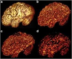 Aspergers has not yet been identified in the brain. Gray Matter Textural Heterogeneity As A Potential In Vivo Biomarker Of Fine Structural Abnormalities In Asperger Syndrome The Pharmacogenomics Journal