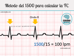 1mv x10 mm 12 resumiendo: Pin En Como Leer Un Ekg