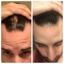 Maybe you would like to learn more about one of these? It S Been Two Months Of Applying Minoxidil Twice A Day Every Day I Started Seeing Hair Growth My 3rd Week With Derma Rolling Going Into The Second Month The Front Seems To