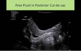 Pelvic Sonography Sonography Medical Ultrasound Diagnostic Medical Sonography