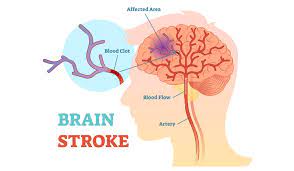 Cerebral infarction can cause death and permanent disability. Neurobiologists Actually Reversed Stroke Damage Using Human Skin Cells The Week