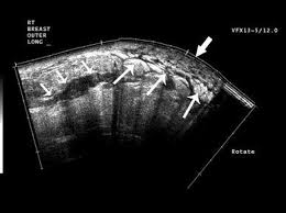 When cancer is suspected, imaging techniques reveal accurate details of tumours, increasing the chances of successful treatment; Inflammatory Breast Cancer Pet Ct Mri Mammography And Sonography Findings Springerlink