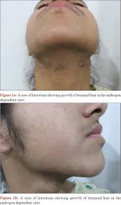 Graves disease is an autoimmune disorder that leads to an overactive thyroid gland frequent bowel movements. Indian Journal Of Dermatology Venereology And Leprology Hair Manifestations Of Endocrine Diseases A Brief Review