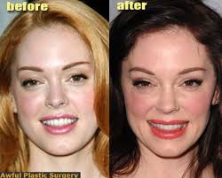 Celebrity Plastic Surgery Before After 56 Pics Celebrity Plastic Surgery Celebrity Surgery Plastic Surgery