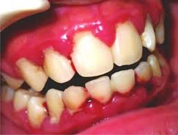 Gusi bengkak juga dikenali sebagai gingivitis. Gusi Berdarah Punca Punca Dan Rawatan Jiwasihat