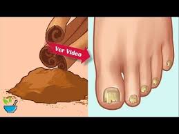 Ningun Hongo Sobrevive A Este Potente Germicida Con Canela Aqui Te Deci Infeccion Por Hongos Remedio Para Hongos Remedios Para Hongos En Los Pies