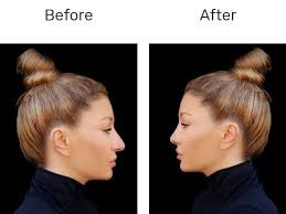 Best Nose Plastic Surgery Hyderabad Nose Plastic Surgery Nonsurgical Nose Job Nose Surgery