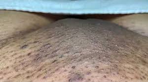 Douse a pair of tweezers in alcohol place in a pan of boiling water for three minutes to sterilize the instrument. Ingrown Hairs Youtube