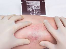 Estos coágulos generalmente ocurren en la parte inferior de las venas de las piernas. Que Es La Trombosis Venosa Profunda Revista Salud Y Cardiologia