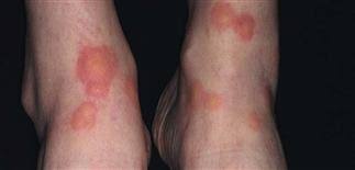 Image result for flea bites