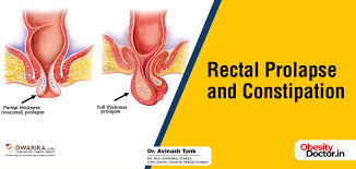 Image result for Rectal prolapse