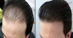 Sac Cikaran Serum Sac Cikaran Serum Saccikaranserum Haare Nachwachsen Behandlung Von Haarausfall Haarkuren