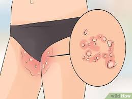 Jock itch is a pretty common fungal infection of the groin and upper thighs. How To Treat Jock Itch 14 Steps With Pictures Wikihow