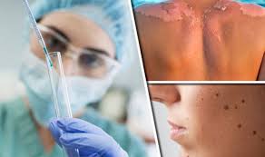 What are the early warning signs of skin cancer? Skin Cancer Spread Stopped Disease Treated With Breakthrough Drug Express Co Uk