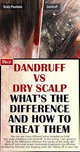 Dandruff Vs Dry Scalp What S The Difference And How To Treat Them Dry Scalp Itchy Dry Scalp Remedy Dry Scalp Remedy