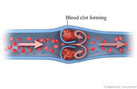 Learning About How To Prevent Blood Clots