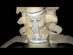 Spinal Fusion 2010 Spinal Fusion Sciatic Nerve Surgery Spine Surgery