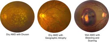 Resultado de imagen de atrophic amd