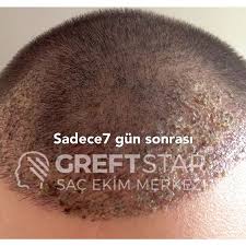 Greft Star Adli Kullanicinin Sac Ekimi Ordu Panosundaki Pin Instagram Sac