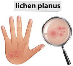 Maybe you would like to learn more about one of these? Lichenul Plan Ce Este Simptome Tratamentul De Actualitate Newsmed Ro