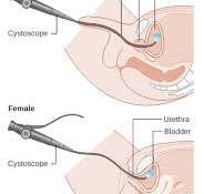 Cystoscopy - Wikipedia