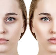 ‫5 تا از بهترین کرم دور چشم برای رفع سیاهی و گودی - هلسانا‬‎