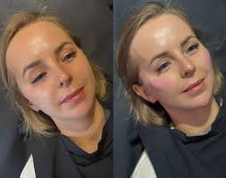 𝒖𝒔𝒕𝒂 𝒑𝒓𝒛𝒆𝒅 𝒊 𝒑𝒐 𝒎𝒐𝒅𝒆𝒍𝒐𝒘𝒂𝒏𝒊𝒖 👄 Na zdjęciu widać  efekt zabiegu modelowania ust