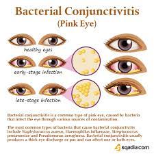 Bacterial Conjunctivitis