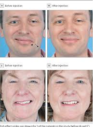 PDF] Effect of Weakening of Ipsilateral Depressor Anguli Oris