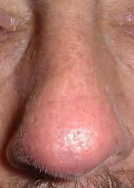 Other times, the condition is diagnosed when a cut from shaving does not heal. Local Reactions To Imiquimod In The Treatment Of Basal Cell Carcinoma