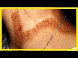 Pellagra is a disease manifested due to a lack of vitamins or malnutrition with a lack or deficiency in nicotinic acid and pellagra. Symptome Von Pellagra Youtube
