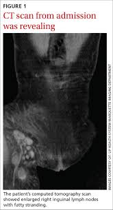 The symptoms and signs of pancreatic cancer are usually common in both men and women. 6 Day History Of Fever Groin Pain And Swelling Recent Hiking Trip In Colorado Dx Mdedge Family Medicine