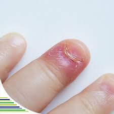 Image result for mykoza nehtů