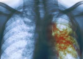 Penyakit tuberkulosis yang merupakan entitas penyakit yang disebabkan bakteri ini telah tercatat. Rumah Sakit Jiwa Prof Dr Soerojo Magelang Stop Rantai Penyebaran Tuberculosis