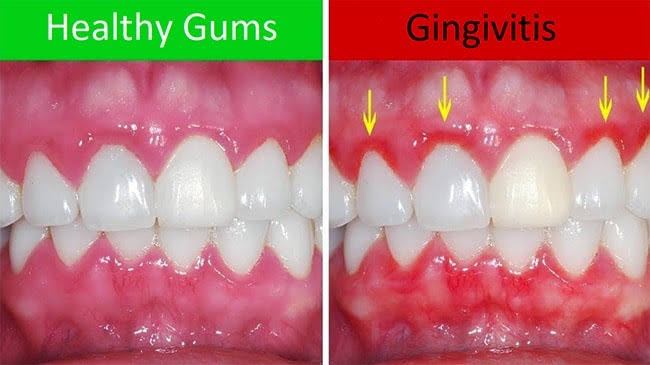 Gum treatment product image