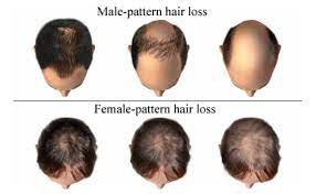 Androgenic alopecia is the most common cause of hair loss in both men and women. Androgenic Alopecia Aa Aesthetic